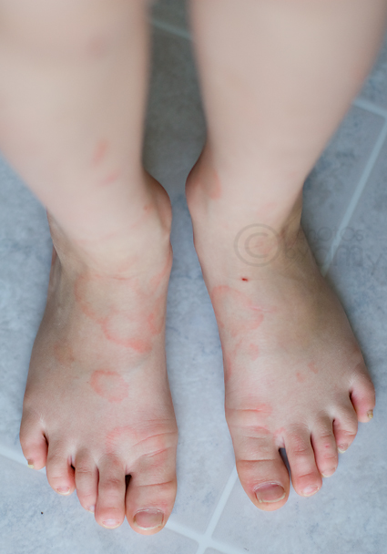 rash